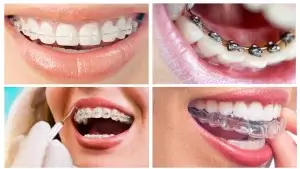 أنواع التقويم الأسنان بالصور