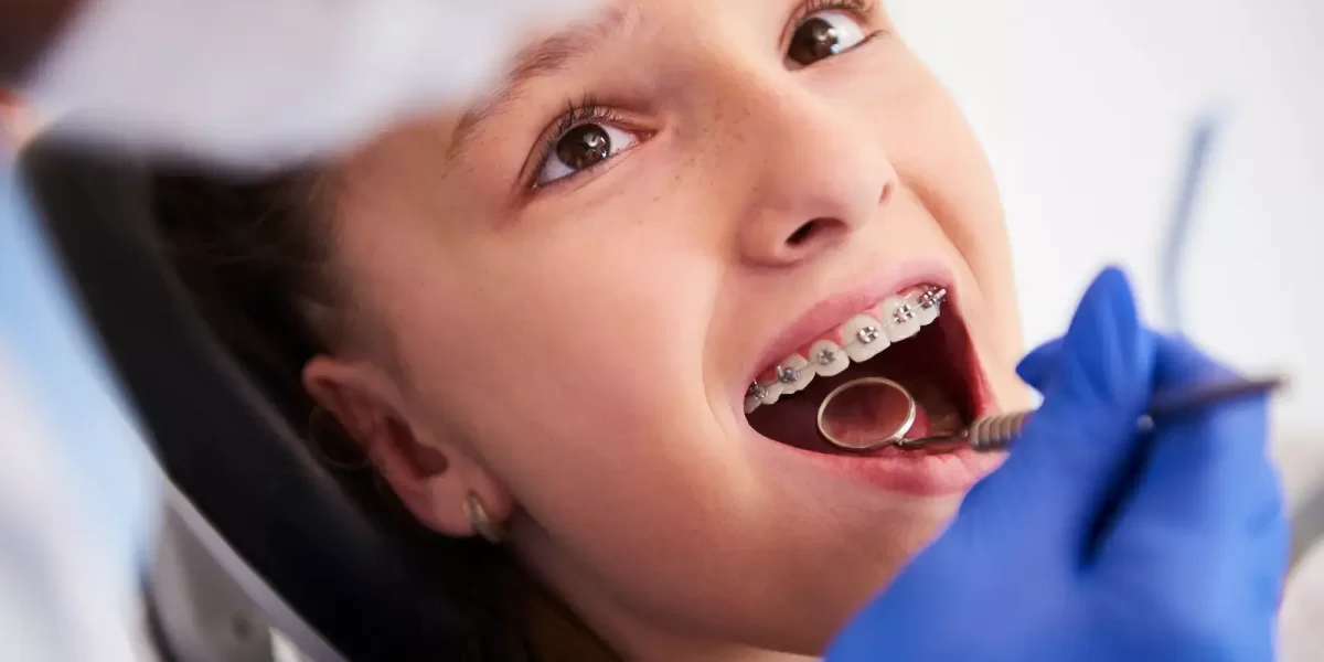 تقويم الفك العلوي للاطفال تقويم الفك العلوي للاطفال