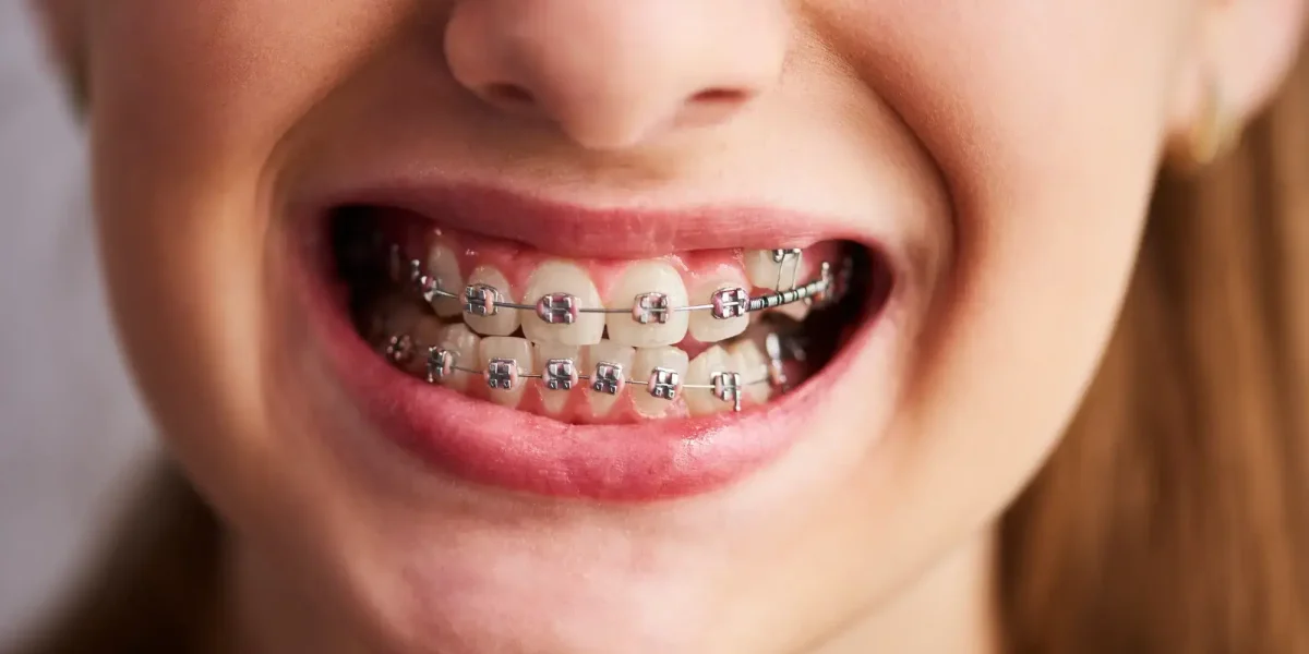 اشكال تقويم الاسنان للاطفال