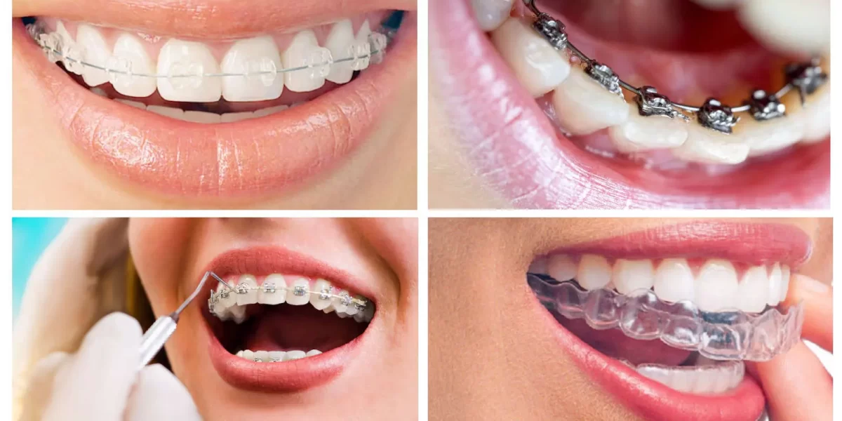 Types of Braces for Teeth and Cost