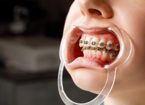 A young woman with metal braces is being examined by an orthodontist. Correction of the bite of teeth in the dental clinic. Concept of healthy teeth.